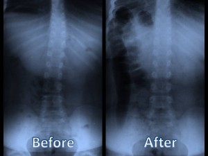 Before and after picture of network chiropractic care